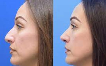 Understanding the Closed Nose Job: A Comprehensive Guide to This Subtle Yet Powerful Rhinoplasty Technique