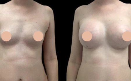 Achieve Your Dream Look with the Best Breast Augmentation Surgeon in Dubai