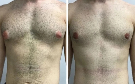 How the Best Gynecomastia Surgeon in Dubai Helps Teens and Young Adults