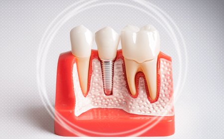 Where Beauty Meets Confidence: Dental Implants in Dubai