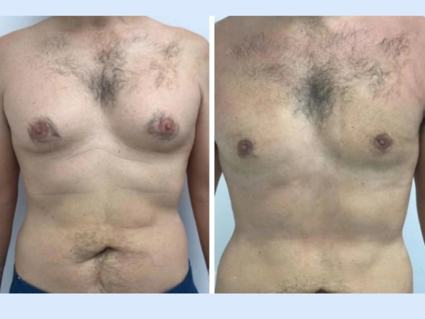 How Gynecomastia in Dubai Surgery Can Improve Your Confidence