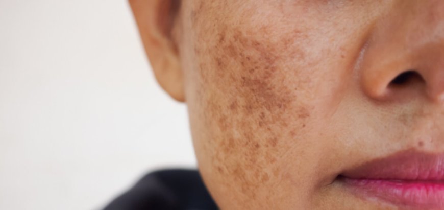 Understanding the Cost of Melasma Treatment in Islamabad