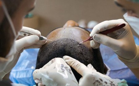 Permanent Solution for Hair Loss: Hair Transplant in Delhi with FUE, PRP, and Expert Grafting