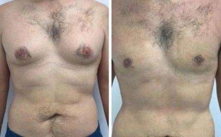 Effective Ways to Navigate Gynecomastia Surgery Expenses
