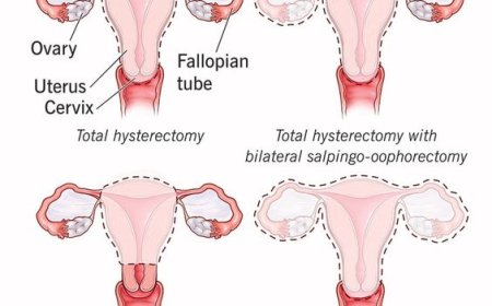 Everything You Need To Know About Hysterectomy Surgery