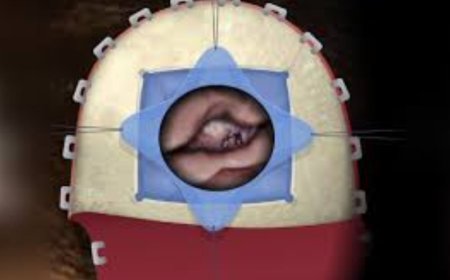 What Is a Craniotomy? A Complete Guide to Brain Surgery