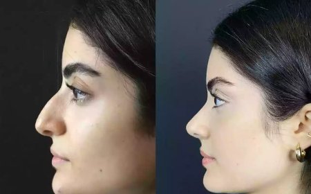 Types of Rhinoplasty in Dubai: Which One Do You Need?