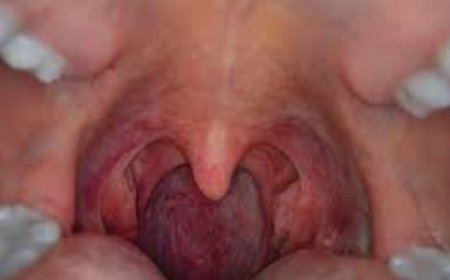 A Comprehensive Guide to Throat Cancer Treatment
