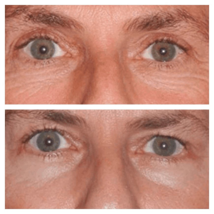 What Makes Eye Bag Removal Surgery in Dubai a Popular Choice: Expert Advice from the Best Surgeons