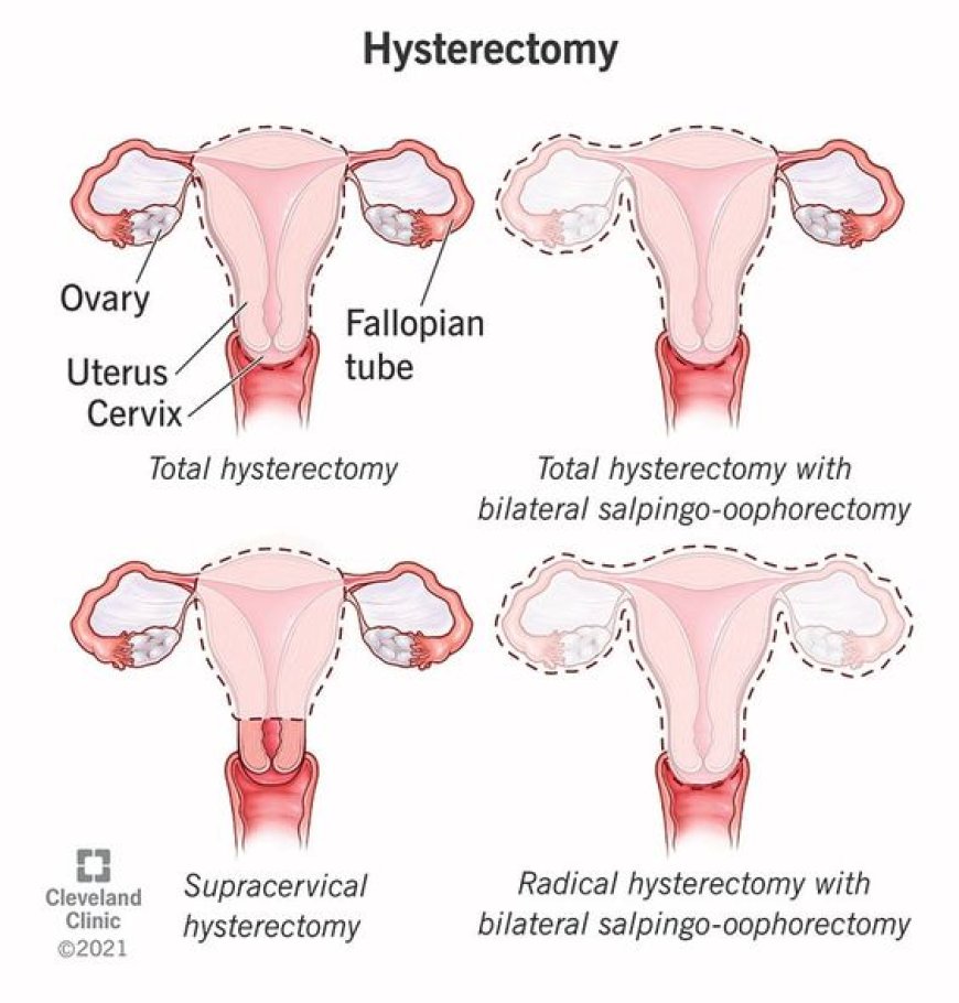 Everything You Need To Know About Hysterectomy Surgery