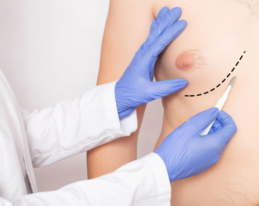 Hormonal Treatments vs. Surgery – Which Is More Effective for Gynecomastia?