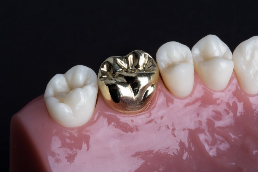 5 Signs You May Need a Dental Bridge in Islamabad