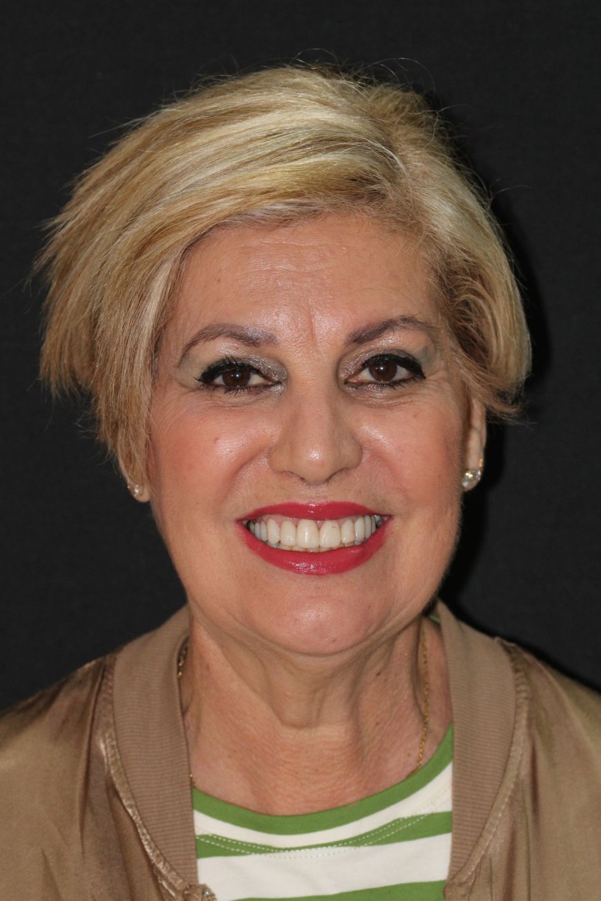 Implantes de Carga Inmediata en Hospitalet de Llobregat Tratamiento Rápido y Seguro